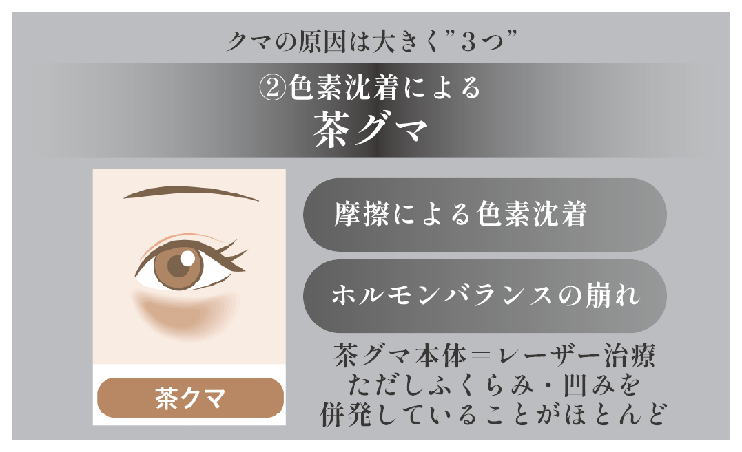 色素沈着による”茶グマ”
